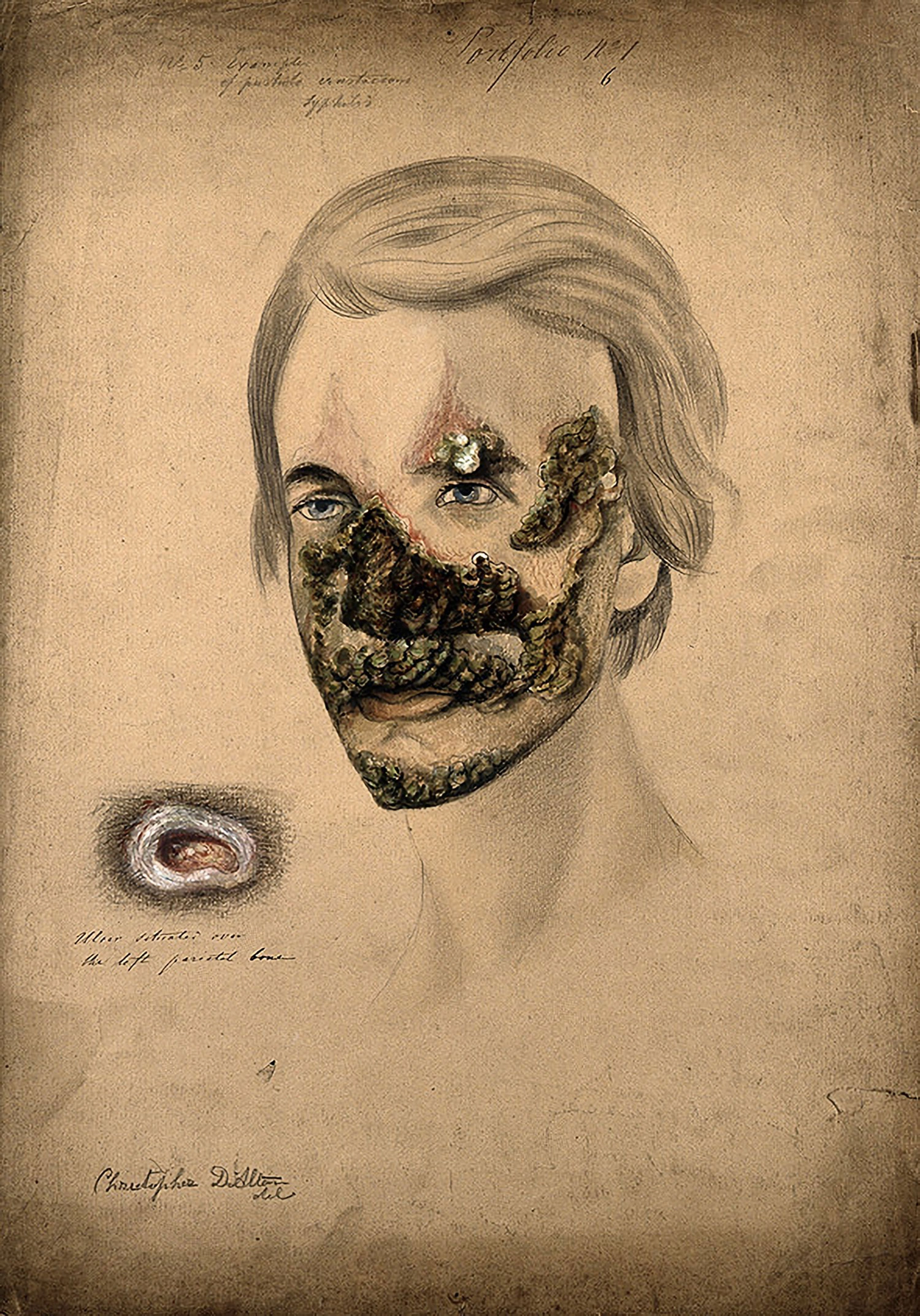 This medical illustration portrays a face which consumed by lesions from the chin to the  nose, as well as the left temple and eyebrow. The legions are nearly black, with red inflammation at the periphery. 