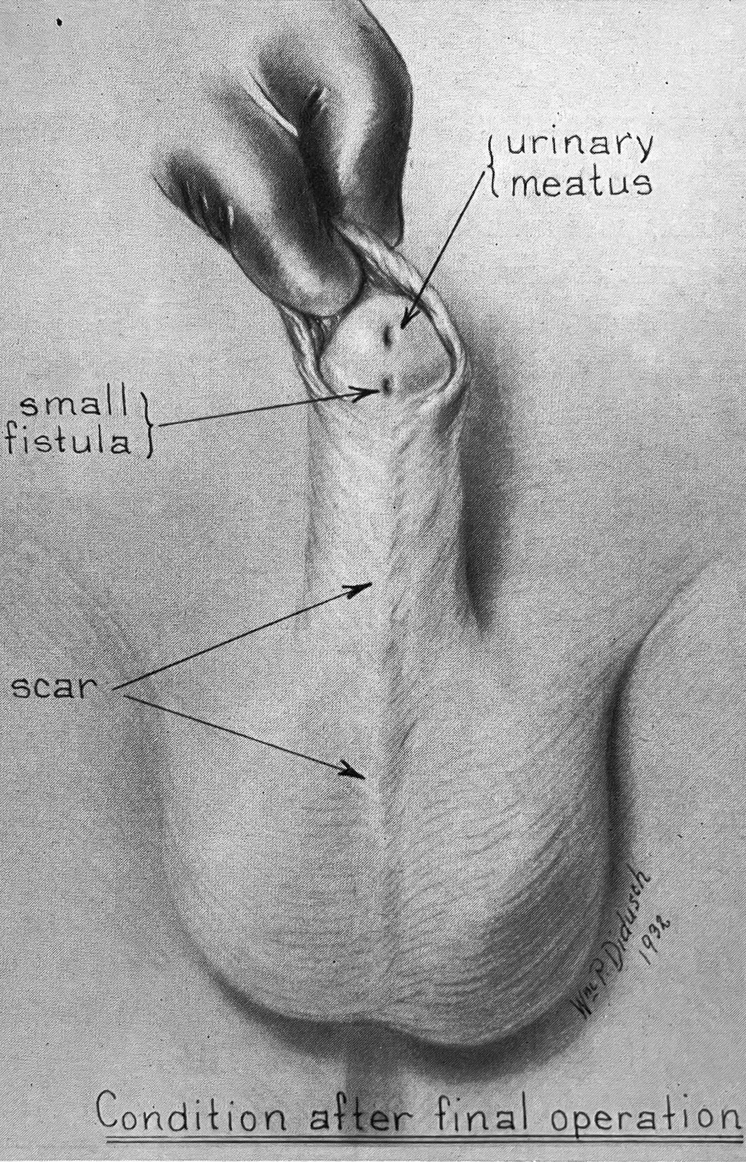 Medical illustration titled “Condition after final operation” shows a reconstructed penis, with annotations pointing to the “urinary meatus,” “scar,” and “small fistula.”