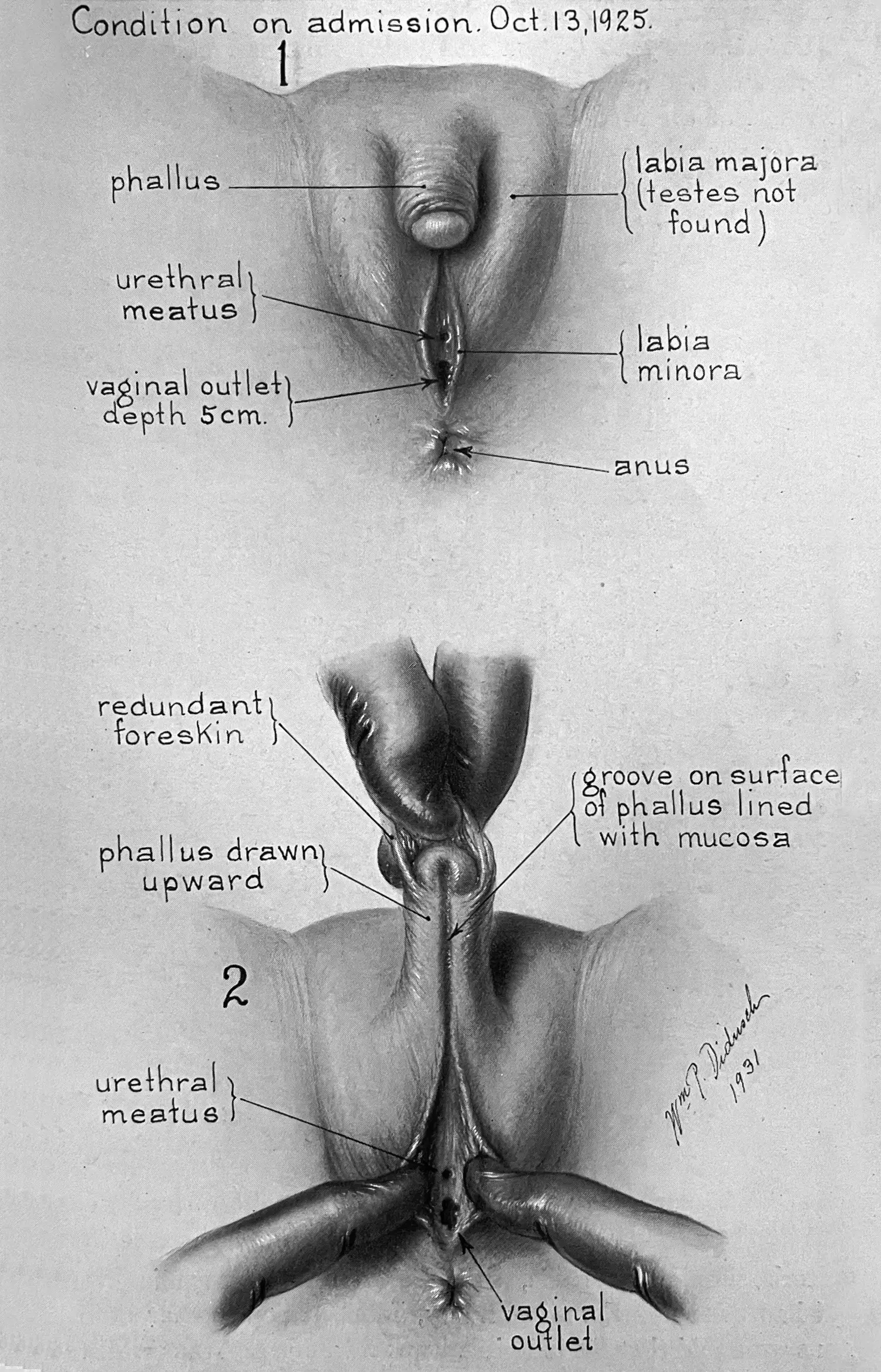 Two-part medical illustration titled “Condition on admission, Oct. 13, 1925” shows two views of the patient’s genitalia. Annotations point to the “phallus,” “vaginal outlet,” and “labia majora (testes not found)” among others.