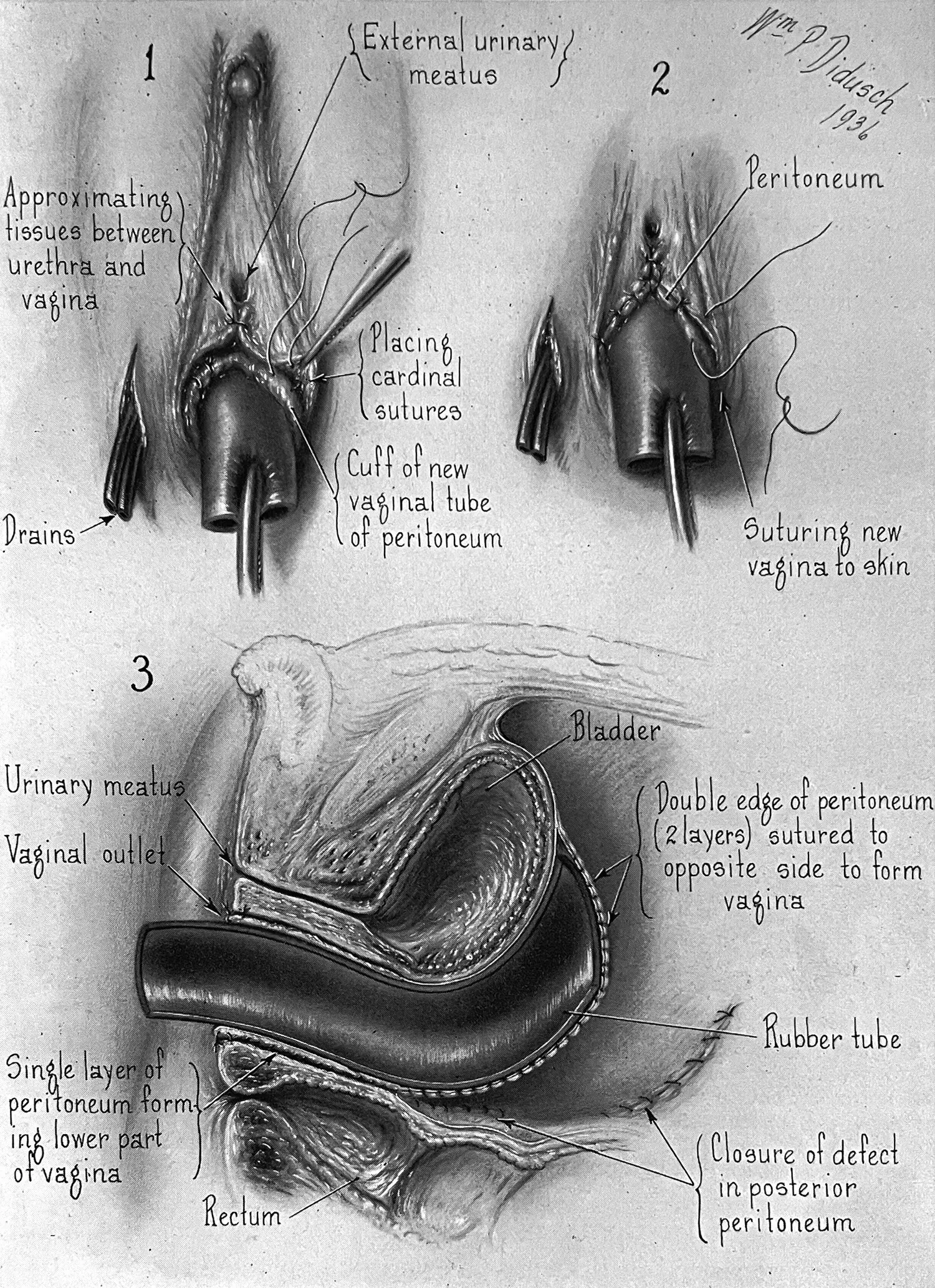 Hand-drawn medical illustrations showing three steps in the surgical construction of an artificial vagina. Dated 1936.